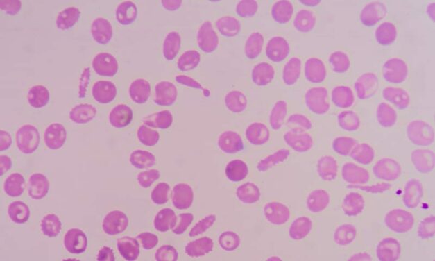 Breakthrough Biologics: Changing the Thalassemia Treatment Paradigm